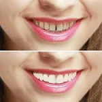 Imako Cosmetic Upper Teeth for Women (Small, Natural Color)