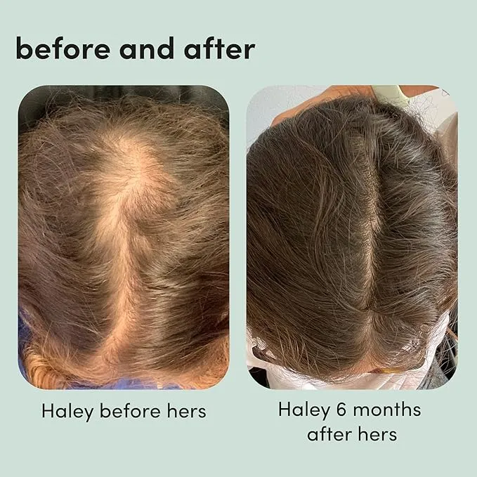 hers Hair Regrowth Treatment for Women with 5% Topical Minoxidil Foam for Hair Loss and Thinning Hair, Unscented No Drip Formula, 4 Month Supply