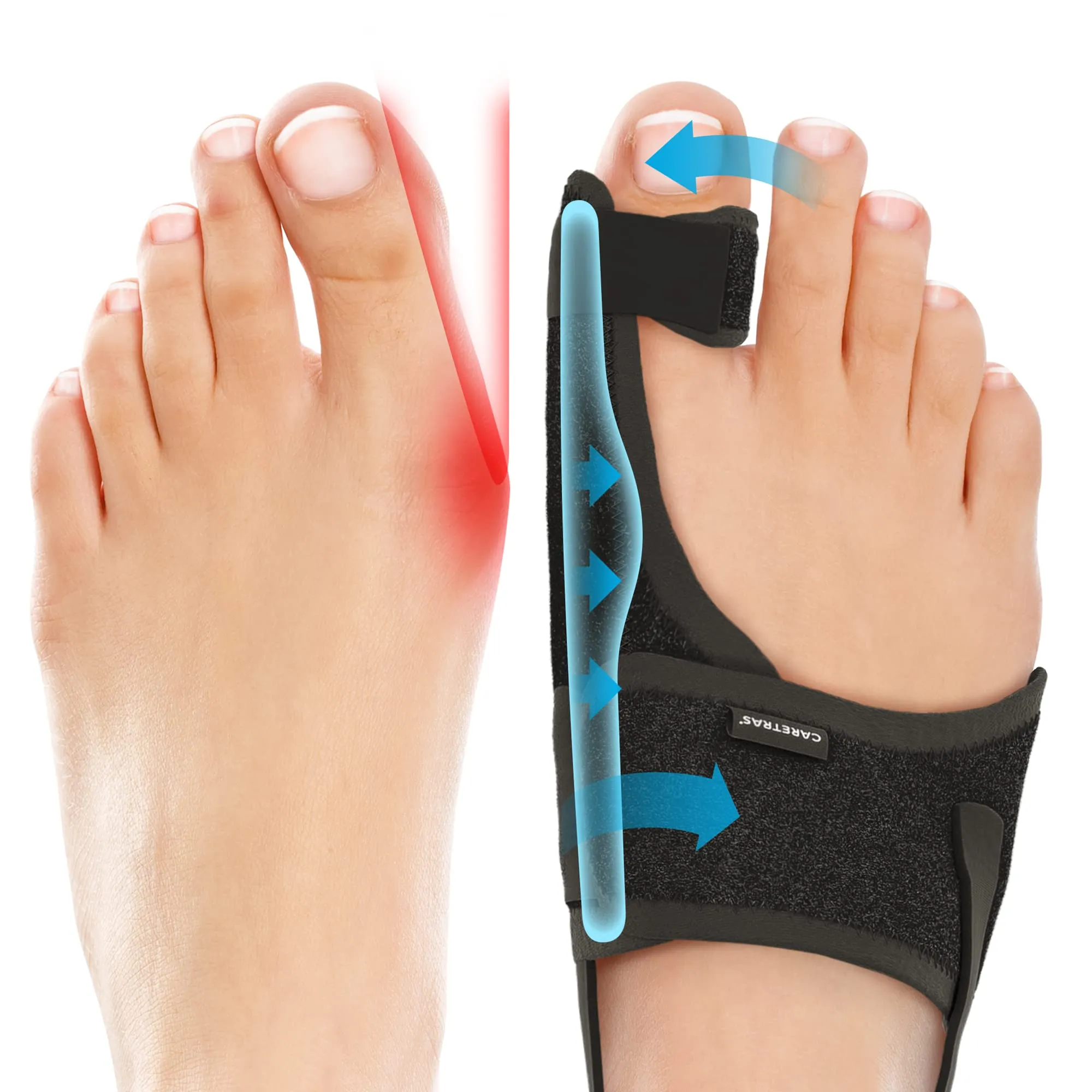 Caretras Bunion Corrector Orthopedic Bunion Splint