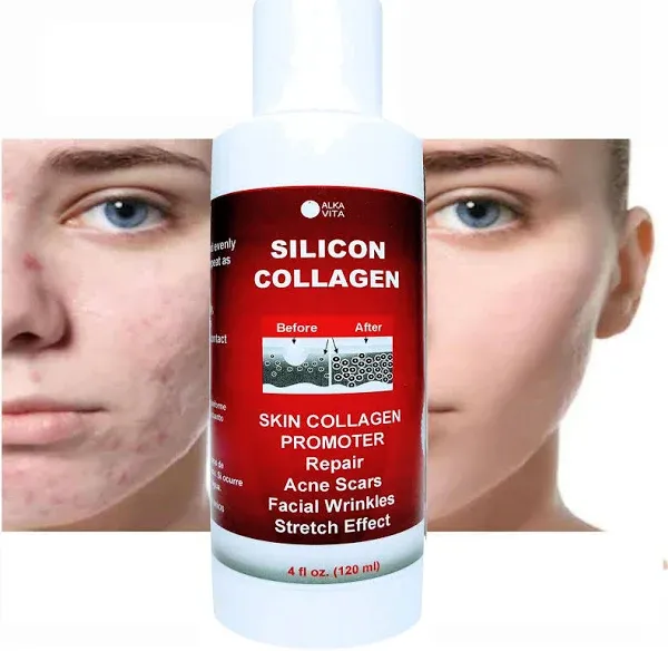 Skin Scars Silicon and Collagen Hydrolyzed Gel Resurfacing Skin Collagen Promoter For Indented Atrophic Rolling Face Scars By ALKA VITA