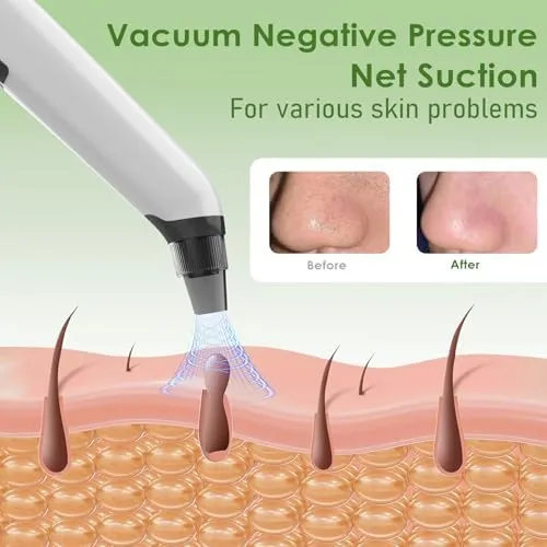 Blackhead Remover Vacuum