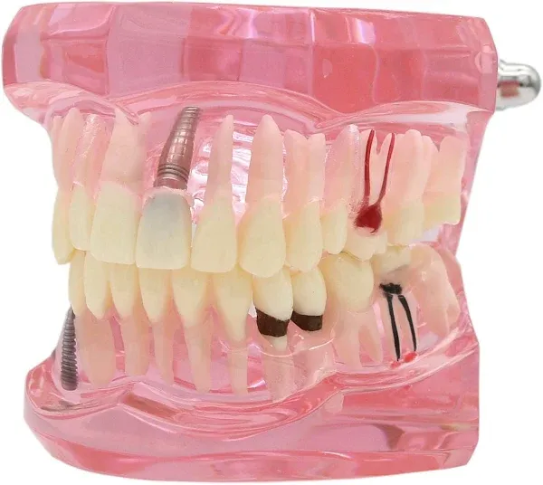 Teeth Model Teeth Typodonts Dental Implant Study Analysis Demonstration Teeth Model #2001 with Restoration Pink