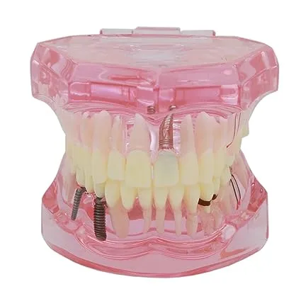 Dentalmall Teeth Model Teeth Typodonts Dental Implant Study Analysis Demonstration Teeth Model #2001 with Restoration Pink