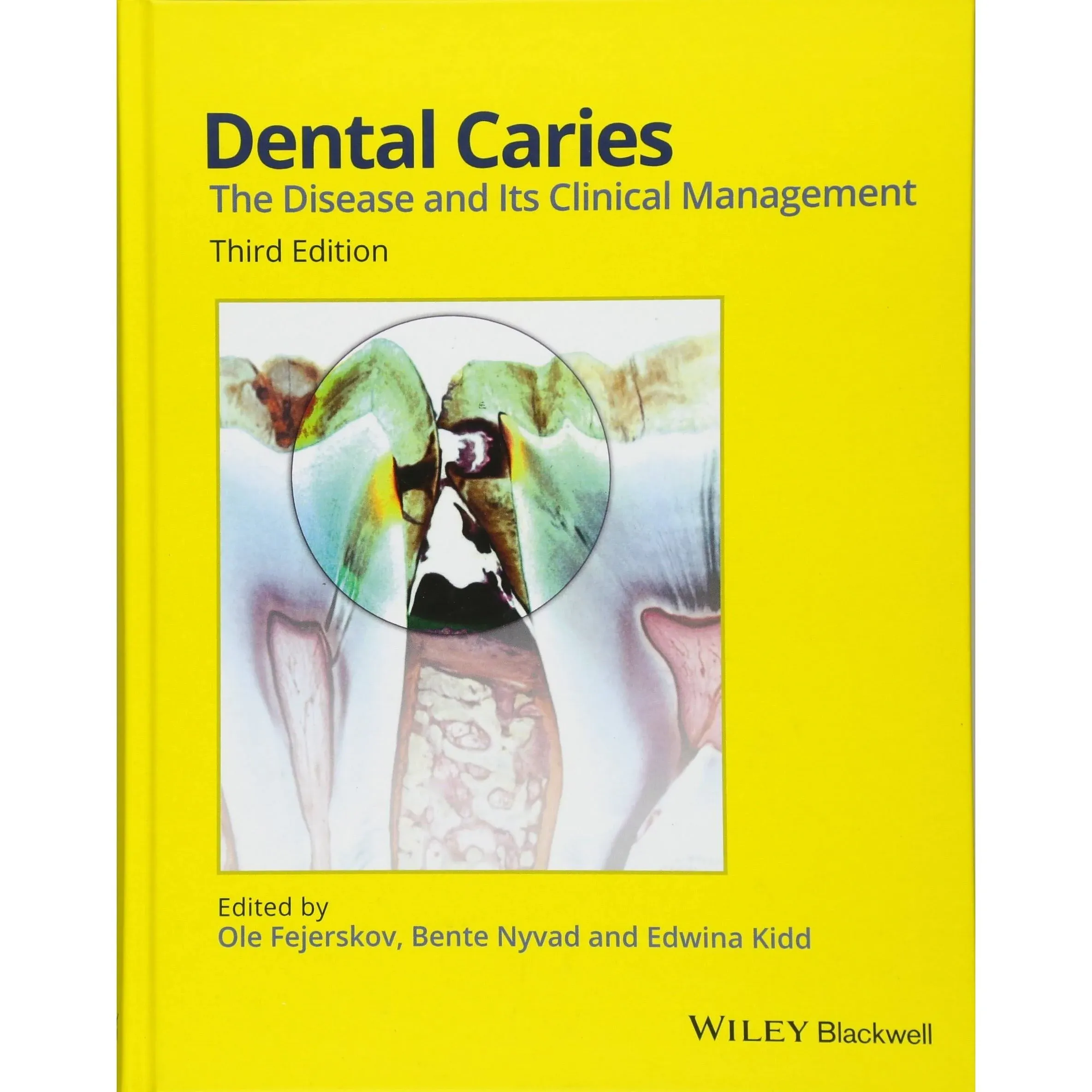 Dental Caries: The Disease and its Clinical Management