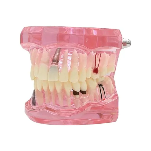 Dentalmall Teeth Model Teeth Typodonts Dental Implant Study Analysis Demonstration Teeth Model #2001 with Restoration