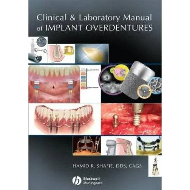 Clinical and Laboratory Manual of Implant Overdentures