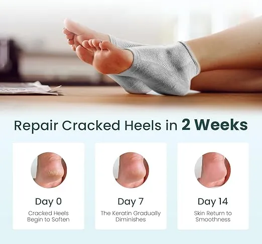 Moisturizing Heel Socks for Cracked Heel Treatment - Promifun 2 Pairs Moisturizer Socks - Heel Socks for Dry Cracked Feet - Cracked Heel Repair - Heel Socks for Women & Men (Gray)